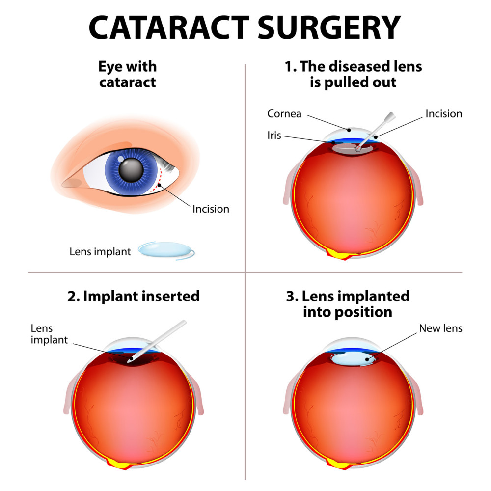 Cataracts - Plantation Eye Associates